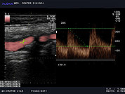 Ultrazvok vratnih žil 25, Zožitev notranje karotidne arterije s povišanimi hitrostmi