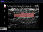 Ultrazvok vratnih žil 26, Opornica (stent) v karotidni arteriji