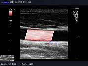 Ultrazvok vratnih žil 41, Normalen izvid skupne karotidne arterije