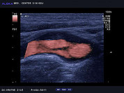 Ultrazvok vratnih žil 47, Maščobno fibrozni plak v notranji karotidni arteriji