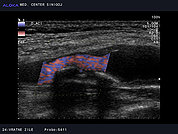 Ultrazvok vratnih žil 45, Kalciniran plak v notranji karotidni arteriji