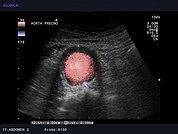 Ultrazvok abdominalne aorte 5, Anevrizma abdominalne aorte