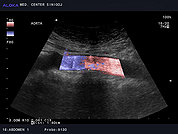 Ultrazvok abdominalne aorte 6, Normalen izvid