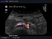 Ultrazvok ledvične arterije 2, Normalna desna ledvična arterija