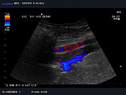 Ultrazvok trebušnih žil 4, Tromboza iliakalnih ven