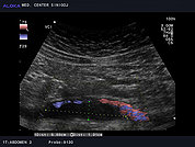 Ultrazvok trebušnih žil 4, Tromboza vene cave inferior (VCI)