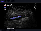 Ultrazvok trebušnih žil 5, Tromboza vene iliake externe