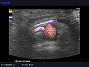 Ultrazvok ledvične arterije 11, Normalen izvid (barvni dopler)