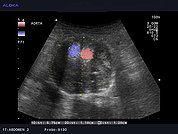 Ultrazvok abdominalne aorte 3, Anevrizma s stensko trombozo