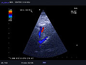 Ultrazvok možganskih žil -TCD 2, desna in leva vertebralna arterija in arterija bazilaris