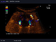 Ultrazvok možganskih žil -TCD 3, vertebralni arteriji