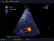 Ultrazvok možganskih žil -TCD 3, Anevrizma na ACoA