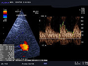 Ultrazvok možganskih žil -TCD 4, Anevrizma ACA
