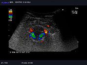 Ultrazvok možganskih žil -TCD 5, vertebralni arteriji