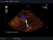 Ultrazvok možganskih žil -TCD 1, desna vertebralna arterija (barvni dopler, normalen izvid)