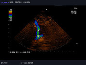 Ultrazvok možganskih žil -TCD 8, Vertebralni arteriji