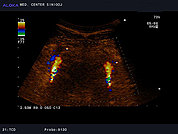 Ultrazvok možganskih žil -TCD 9, Vertebralni arteriji