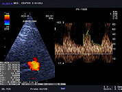 Ultrazvok možganskih žil -TCD 11, Anevrizma ACoA