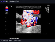 Ultrazvok arterio-venske fistule (AVF) za hemodializo 3, Anastomoza arteriovenske fistule TL tipa (barvni dopler)