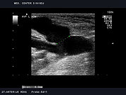 Ultrazvok arterio-venske fistule (AVF) za hemodializo 2, Anastomoza arteriovenske fistule TL tipa