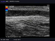 Ultrazvok ven 3, Tromboza vene saphene magne (VSM)