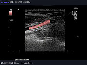 Ultrazvok arterij roke 4 -Normalen ultrazvočni izvid arterije radialis