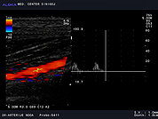 Ultrazvok arterij na nogi 2 -Znižane hitrosti v arteriji