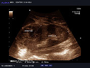 Ultrazvok ledvic 21, Hematom ob ledvici in vranici